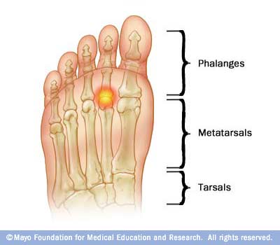 r7_metatarsalgia.jpg